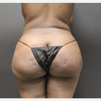 25-34 year old woman treated with Smart Lipo before 3286830