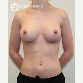25-34 year old woman treated with Breast Augmentation after 3137824