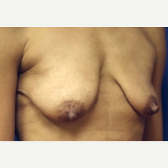 38 year old woman with Breast Augmentation before 3103911