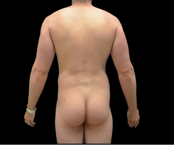 30 Year Old Male Treated For Abdominal And Flank Definition 1269162