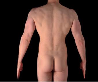 30 Year Old Male Treated For Abdominal And Flank Definition 1269162