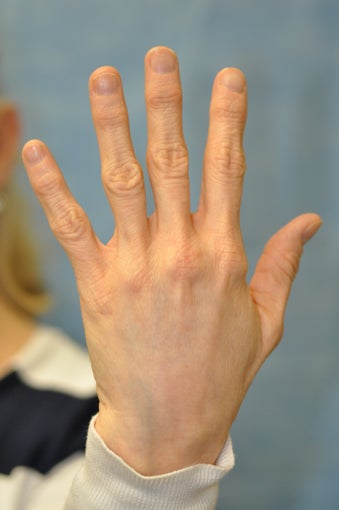 56 Year Old Female Treated for Unacceptable Cosmetic Appearance of Hands after 1012736