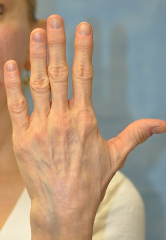 56 Year Old Female Treated for Unacceptable Cosmetic Appearance of Hands before 1012736