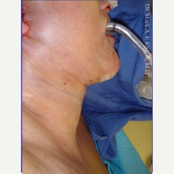 55-64 year old woman treated with Facelift Revision after 2289383
