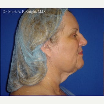 55-64 year old woman treated with Facelift Revision before 2289383