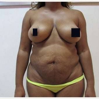 35-44 year old woman treated with Tummy Tuck before 1870298