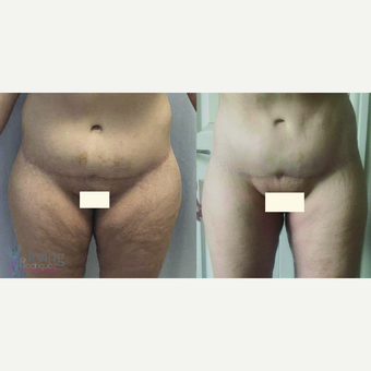 35-44 year old woman treated with Thigh Lift before 3442523