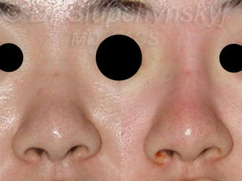 20 Year Old Non-Surgical Rhinoplasty with Radiesse before 1384786