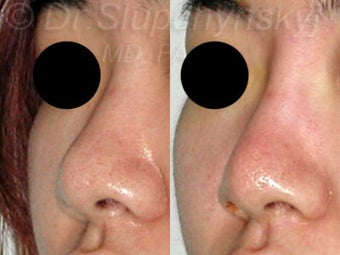20 Year Old Non-Surgical Rhinoplasty with Radiesse 1384786