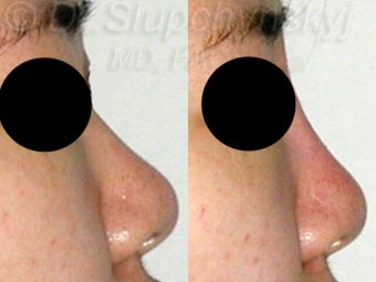 20 Year Old Non-Surgical Rhinoplasty with Radiesse 1384786