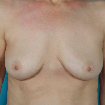Breast Implant Removal, 64 Year Old Patient after 1603693