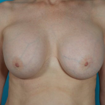 Breast Implant Removal, 64 Year Old Patient before 1603693