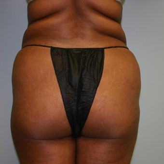 Brazilian Butt Lift before 3667528