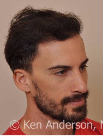 34 yo man - ARTAS Robotic Hair Transplant Surgery with PRP and ACell - 8 month post op pics 3009247