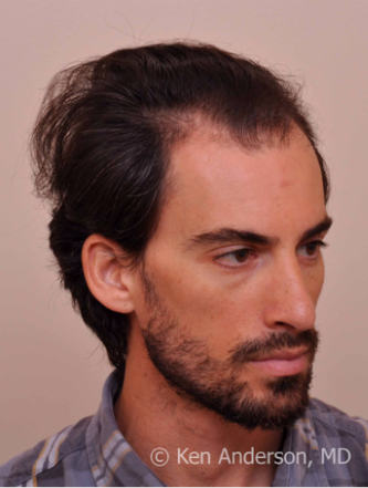 34 yo man - ARTAS Robotic Hair Transplant Surgery with PRP and ACell - 8 month post op pics 3009247