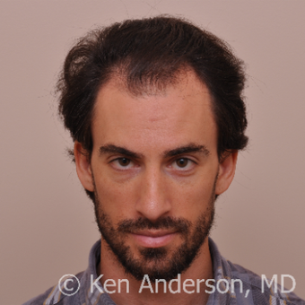 34 yo man - ARTAS Robotic Hair Transplant Surgery with PRP and ACell - 8 month post op pics before 3009247