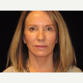55-64 year old woman treated with Facelift after 3508858