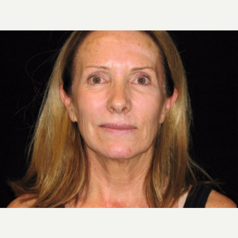 55-64 year old woman treated with Facelift before 3508858