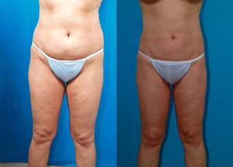 43-year-old woman treated with Liposuction. before 574539