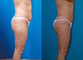 43-year-old woman treated with Liposuction. after 574539