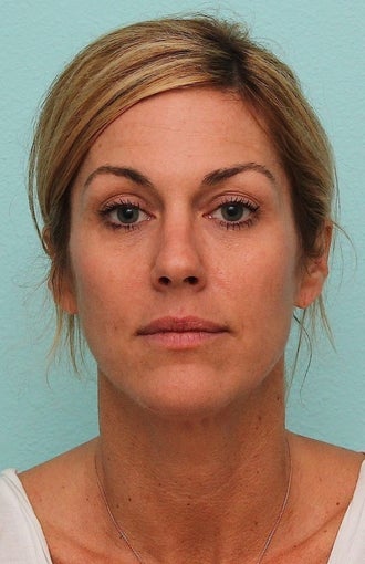MicroLaser Peel / Laser Resurfacing and IPL 1034442