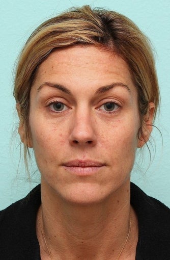 MicroLaser Peel / Laser Resurfacing and IPL 1034442