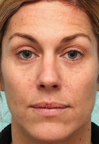 MicroLaser Peel / Laser Resurfacing and IPL before 1034442