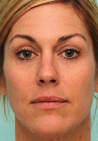 MicroLaser Peel / Laser Resurfacing and IPL after 1034442