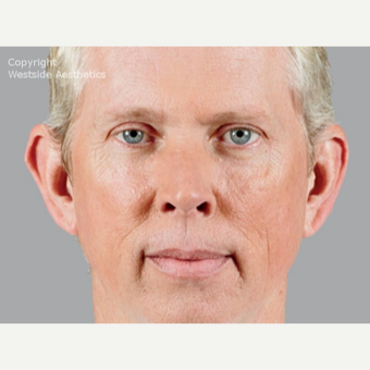 Voluma for Cheeks on Middle-Aged Man before 3065374