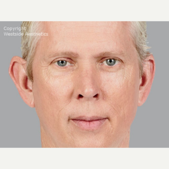 Voluma for Cheeks on Middle-Aged Man after 3065374