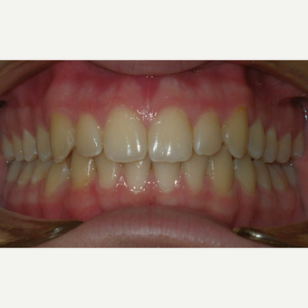 17 or under year old man treated with Invisalign after 3657251