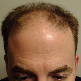 45-54 year old man treated with ARTAS Robotic Hair Transplant before 2803233
