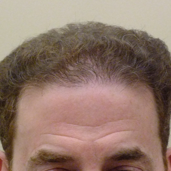 45-54 year old man treated with ARTAS Robotic Hair Transplant after 2803233