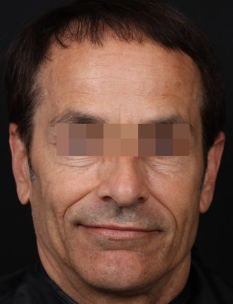 Sculptra and Fillers to Restore Volume before 1358744