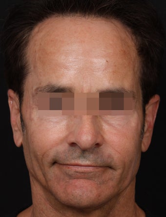 Sculptra and Fillers to Restore Volume after 1358744