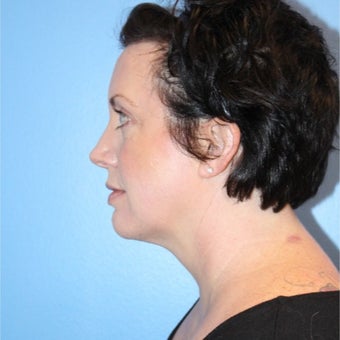 35-44 year old woman treated with Kybella after 2576553