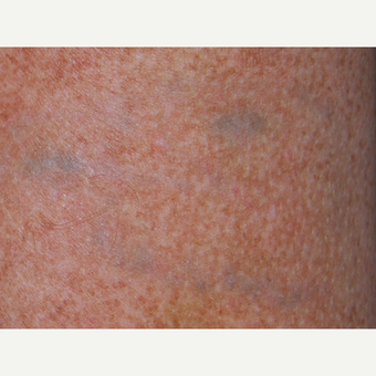 45-54 year old man treated with PicoSure Tattoo Removal after 3149670