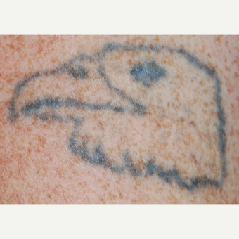 45-54 year old man treated with PicoSure Tattoo Removal before 3149670
