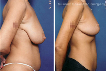 Breast lift (no implants) with nipple reduction after 902746