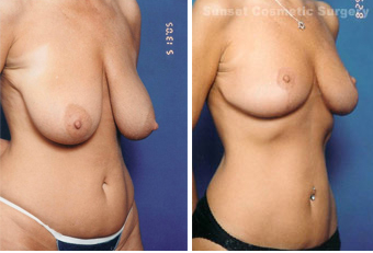 Breast lift (no implants) with nipple reduction before 902746
