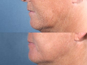 Laser Resurfacing before 104655