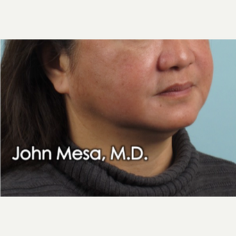 55-64 year old woman treated with Buccal Fat Removal before 3777309