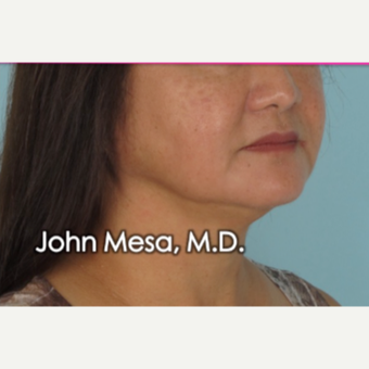 55-64 year old woman treated with Buccal Fat Removal after 3777309