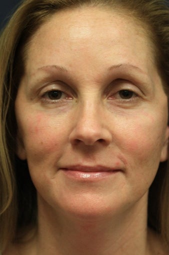 44 year old woman treated with Laser Peel after 1555556