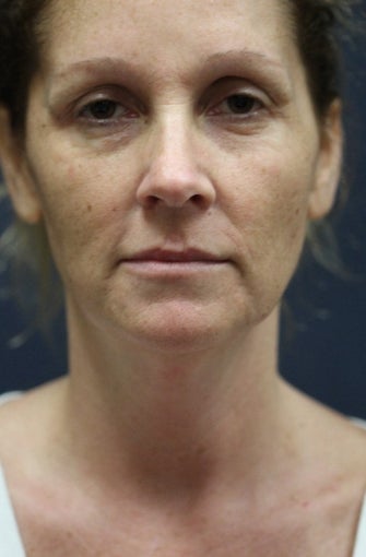 44 year old woman treated with Laser Peel before 1555556