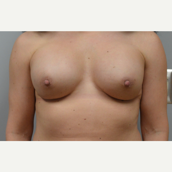 35-44 year old woman treated with Breast Reconstruction after 3167981