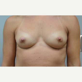 35-44 year old woman treated with Breast Reconstruction before 3167981