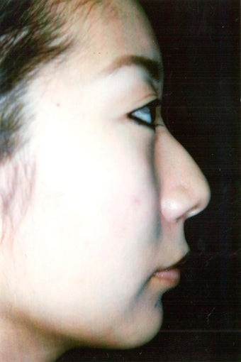 Asian Ethnic Rhinoplasty 1261888