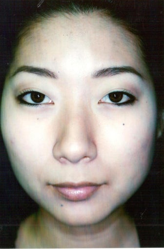 Asian Ethnic Rhinoplasty before 1261888
