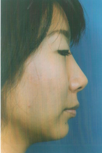 Asian Ethnic Rhinoplasty 1261888
